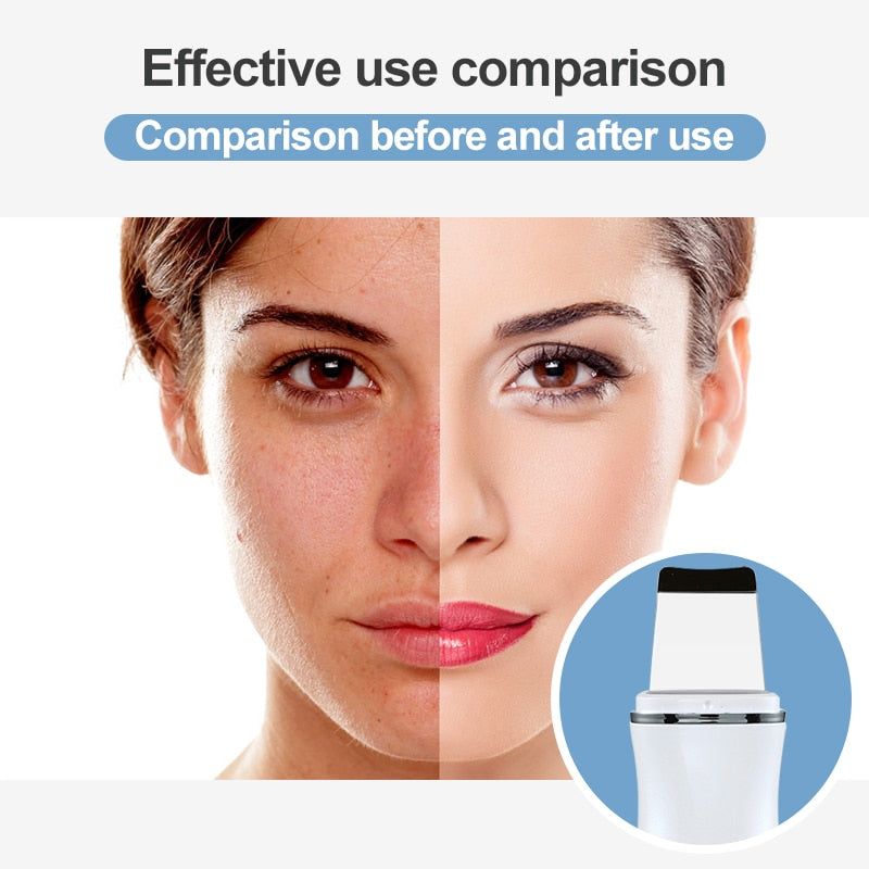 AmazeFan Ultrasonic Skin Scrubber Peeling Shovel Ion Acne Blackhead Remover Deep Cleaning Machine face Lifting Facial Massager